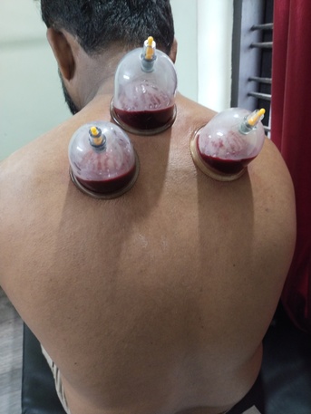 Mumbai, Health, Looking Hijama Cupping Job