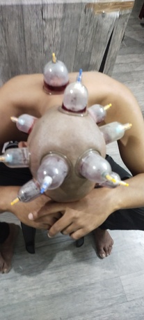 Mumbai, Health, Looking Hijama Cupping Job