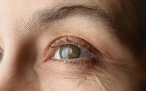 New York, Medical, Cataract Surgery &ndash; Clear Vision Restoration