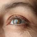 Cataract Surgery &ndash; Clear Vision Restoration