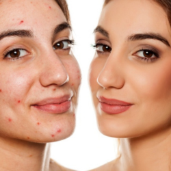 New York, Beautician, Acne Treatments Fort Collins Clear Healthy Skin Solutions