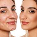 Acne Treatments Fort Collins Clear Healthy Skin Solutions