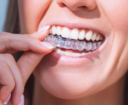 Ahmedabad, Dental, Clear Teeth Aligners For A Perfect Smile | The Dental Wellness Centre