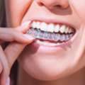 Clear Teeth Aligners For A Perfect Smile | The Dental Wellness Centre