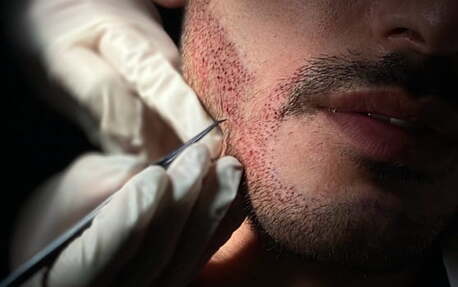 Gurgaon, Health, Get Natural Beard Transplant In Gurgaon | SB Trichology