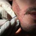 Get Natural Beard Transplant In Gurgaon | SB Trichology