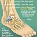 4 Advantages Of Ankle Ligament Tear