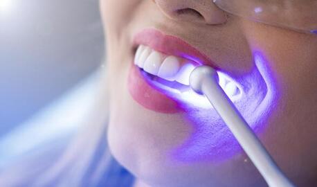 Surrey, Health & Beauty Items, Teeth Whitening Surrey BC