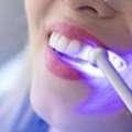 Teeth Whitening Surrey BC