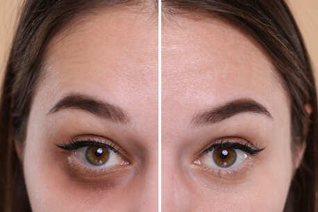 Abu Dhabi, Beautician, Advanced Dark Circle Treatment In Dubai For Brighter, Youthful Eyes