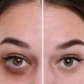 Advanced Dark Circle Treatment In Dubai For Brighter, Youthful Eyes