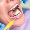 Expert Gum Grafting In Beverly Hills For Healthier, Stronger Gums