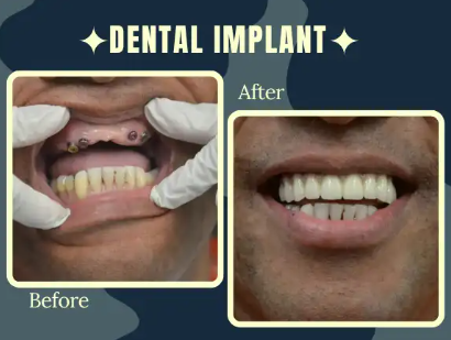 Gurgaon, Dental, Full Mouth Dental Implants In Gurgaon: Cost, Procedure & Complete Guide