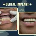 Full Mouth Dental Implants In Gurgaon: Cost, Procedure & Complete Guide