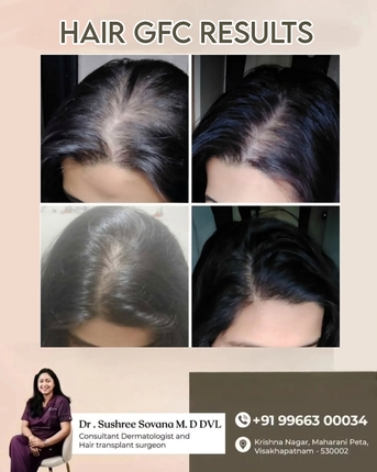 Visakhapatnam, Health, Hair GFC Benefits & Results - Derma One Clinic