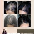 Hair GFC Benefits & Results - Derma One Clinic
