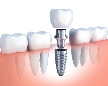 Gurgaon, Dental, Top 10 Dental Implant Clinics In Gurgaon (2026)