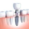 Top 10 Dental Implant Clinics In Gurgaon (2026)