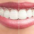 Smile Makeover Mississauga Book Your Visit Today