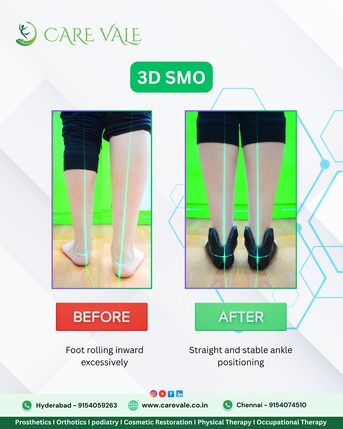 Hyderabad, Food & Drink, Best Artificial Leg  In Hyderabad | CareVale Prosthetics