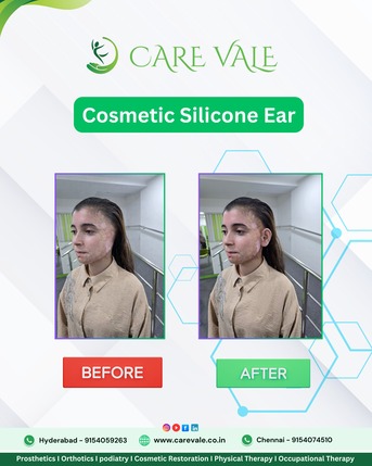 Hyderabad, Food & Drink, Best Artificial Leg  In Hyderabad | CareVale Prosthetics