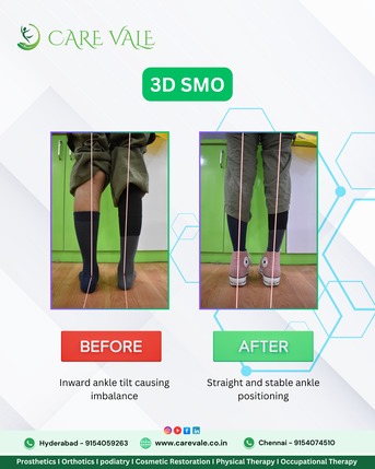 Hyderabad, Food & Drink, Best Artificial Leg  In Hyderabad | CareVale Prosthetics