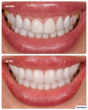 Jumeirah, Dental, Veneer Smile Makeover In Dubai