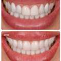 Veneer Smile Makeover In Dubai