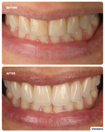 Jumeirah, Dental, Veneer Smile Makeover In Dubai