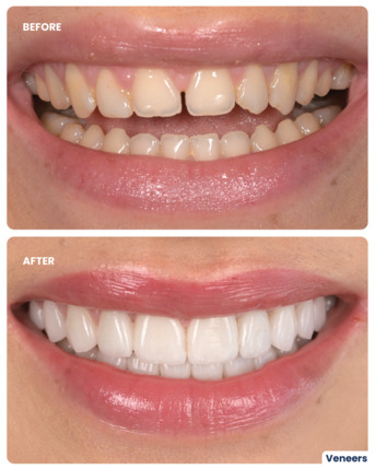 Jumeirah, Dental, Veneer Smile Makeover In Dubai
