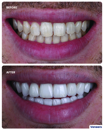 Jumeirah, Dental, Veneer Smile Makeover In Dubai