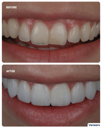 Jumeirah, Dental, Veneer Smile Makeover In Dubai