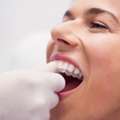Affordable Invisible Braces Dublin | Merrion Square Dental