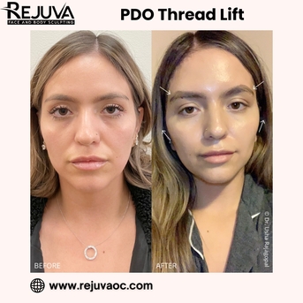 New York, Health, PDO Thread Lift Newport Beach