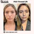 PDO Thread Lift Newport Beach