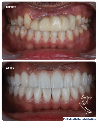 Dubai, Dental, Dental Implants In Dubai