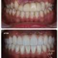 Dental Implants In Dubai