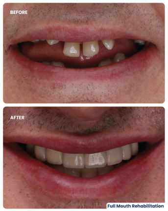 Dubai, Dental, Dental Implants In Dubai