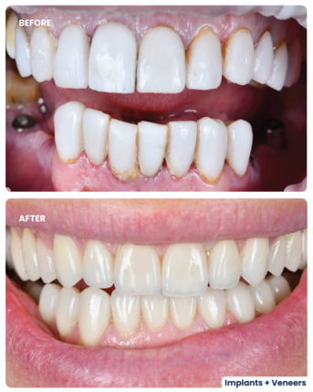 Dubai, Dental, Dental Implants In Dubai