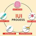 IUI Treatment In Delhi - Dr Rhythm Gupta