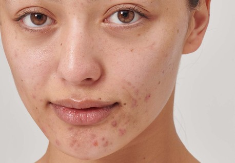 New York, Health, Deep Clean That Resets Acne-Prone Skin
