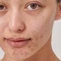 Deep Clean That Resets Acne-Prone Skin