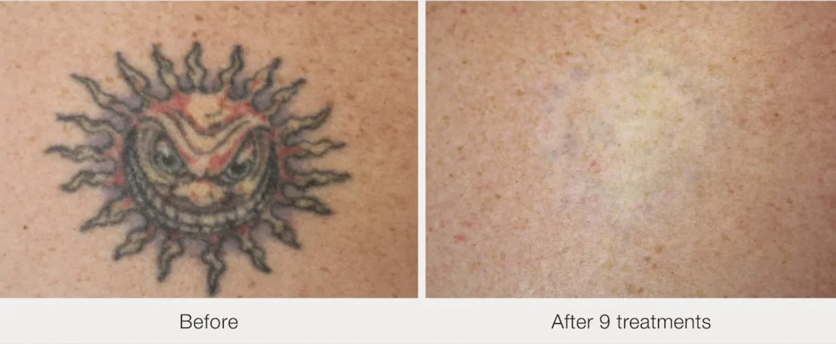 New York, Business, Best Options For Tattoo Removal Nj Services Near You
