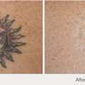 Best Options For Tattoo Removal Nj Services Near You