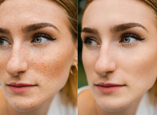 New York, Business, Effective Solutions For Age Spots Removal Treatment