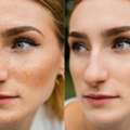 Effective Solutions For Age Spots Removal Treatment
