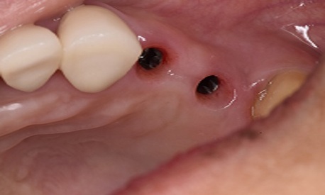 Mexico City, Dental, Holistic Dentist In Mexico &ndash; Natural, Biocompatible Care For Your Health And Smile