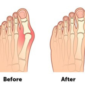 Houston, Medical, Advanced Bunion Surgery In Houston For Pain-Free Walking