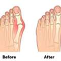 Advanced Bunion Surgery In Houston For Pain-Free Walking
