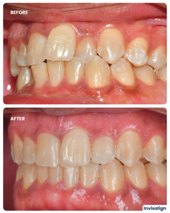 Dubai, Dental, Invisalign Treatment In Dubai